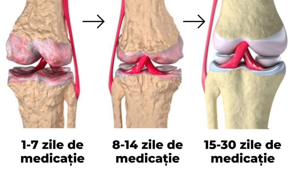 Recuperare articulații în 30 zile